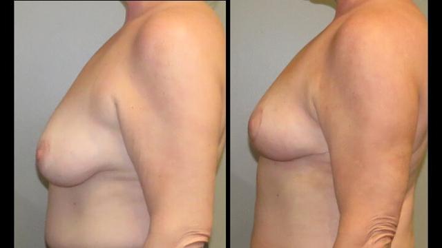 Breast Lift result at Maier Plastic Surgery in Cincinnati, OH