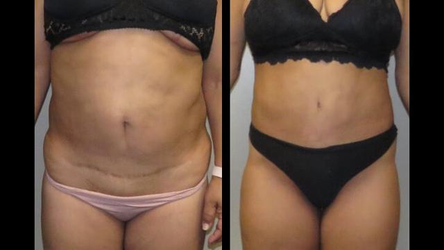 Liposuction result at Maier Plastic Surgery in Cincinnati, OH