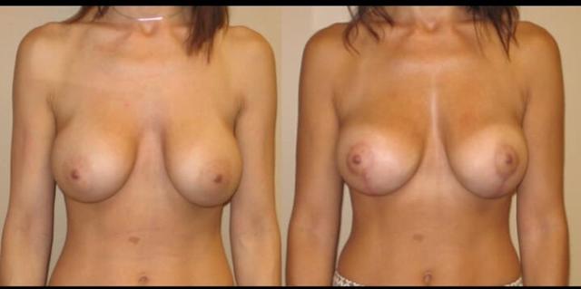 Breast Lift result at Maier Plastic Surgery in Cincinnati, OH