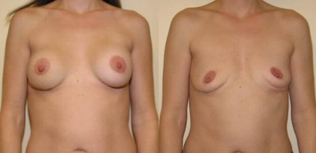 Breast Augmentation result at Maier Plastic Surgery in Cincinnati, OH