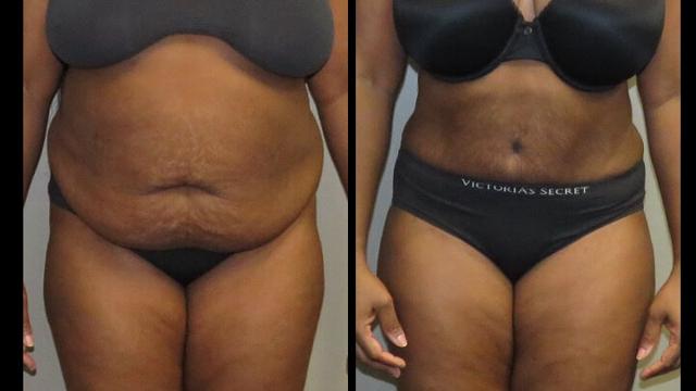 Liposuction result at Maier Plastic Surgery in Cincinnati, OH