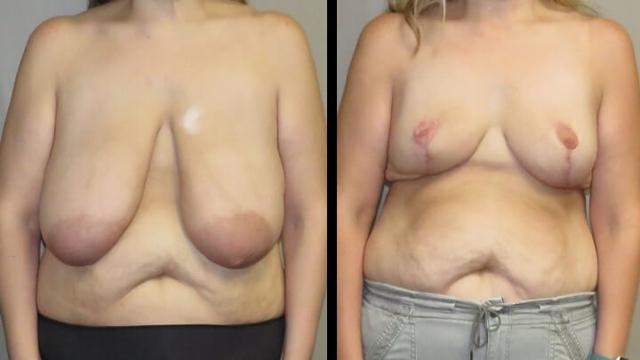 Breast Lift result at Maier Plastic Surgery in Cincinnati, OH