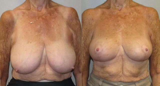 Breast Lift result at Maier Plastic Surgery in Cincinnati, OH