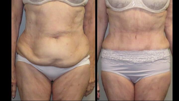 Maier Plastic Surgery liposuction result — Cincinnati, OH