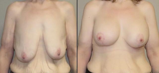 Breast Lift result at Maier Plastic Surgery in Cincinnati, OH