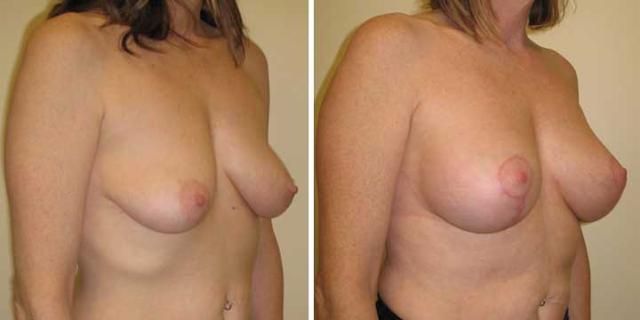 Breast Lift result at Maier Plastic Surgery in Cincinnati, OH