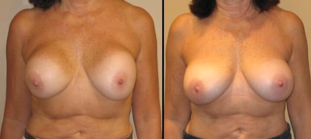 Breast Augmentation result at Maier Plastic Surgery in Cincinnati, OH