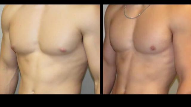 Gynecomastia Surgery result at Maier Plastic Surgery in Cincinnati, OH