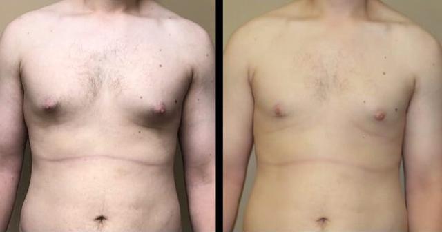 Gynecomastia Surgery result at Maier Plastic Surgery in Cincinnati, OH
