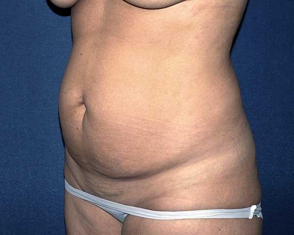 Mini Tummy Tuck before at Hilton Becker, MD in Boca Raton, FL