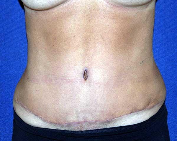 Hilton Becker, MD tummy tuck after — Boca Raton, FL
