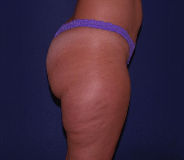Liposuction before at Hilton Becker, MD in Boca Raton, FL
