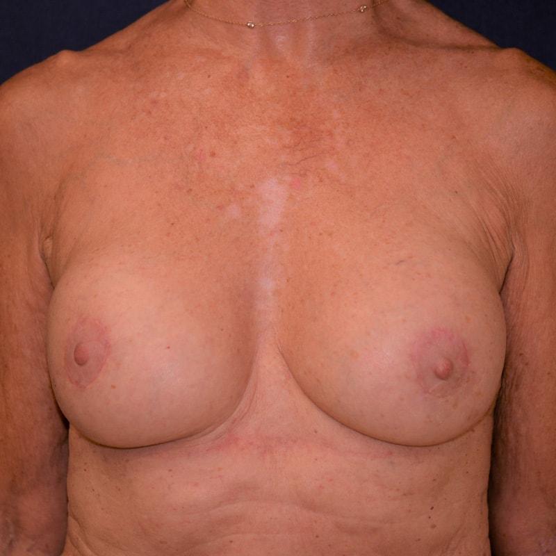Hilton Becker, MD breast lift after — Boca Raton, FL