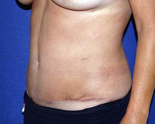 Hilton Becker, MD tummy tuck after — Boca Raton, FL