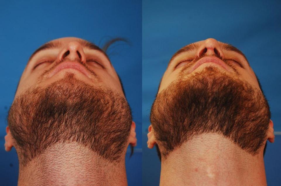 Michael Reilly, MD rhinoplasty result — Washington, DC