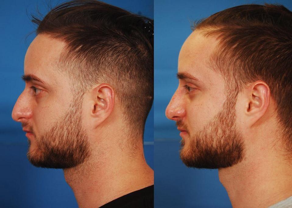 Michael Reilly, MD rhinoplasty result — Washington, DC