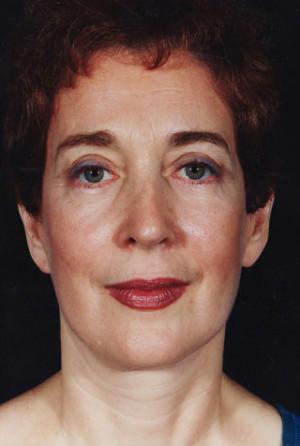 New York Plastic Surgery facelift after — New York, NY