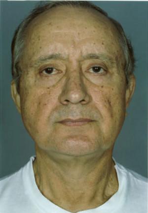 New York Plastic Surgery facelift after — New York, NY