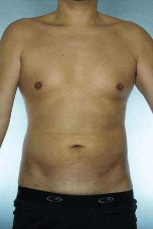 New York Plastic Surgery liposuction after — New York, NY