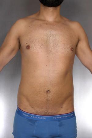 New York Plastic Surgery liposuction after — New York, NY