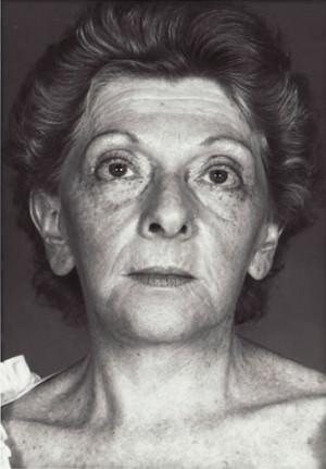 New York Plastic Surgery facelift after — New York, NY