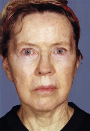 New York Plastic Surgery facelift after — New York, NY