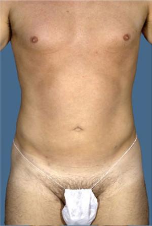 New York Plastic Surgery liposuction after — New York, NY