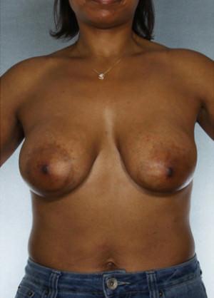 New York Plastic Surgery breast augmentation after — New York, NY