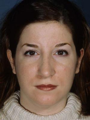 New York Plastic Surgery rhinoplasty after — New York, NY