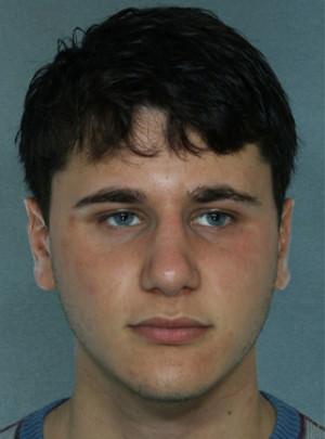 New York Plastic Surgery rhinoplasty after — New York, NY