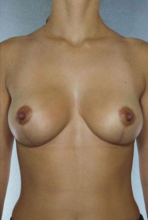 Breast Lift after at New York Plastic Surgery in New York, NY