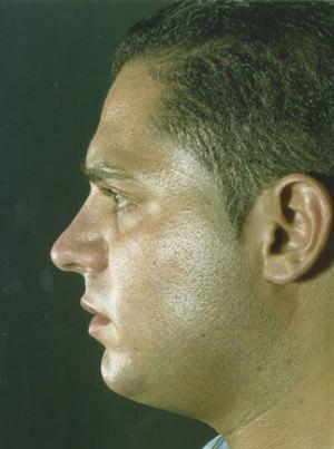 New York Plastic Surgery rhinoplasty after — New York, NY