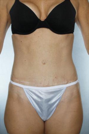 New York Plastic Surgery tummy tuck after — New York, NY