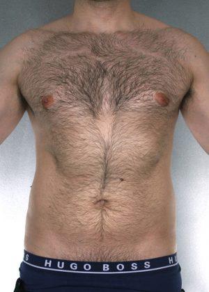 New York Plastic Surgery liposuction after — New York, NY