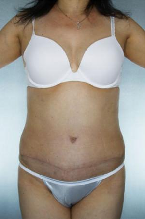 New York Plastic Surgery tummy tuck after — New York, NY
