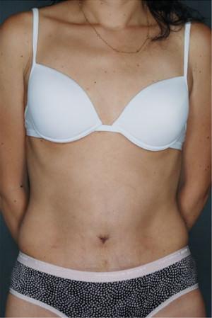 New York Plastic Surgery tummy tuck after — New York, NY