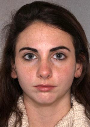 New York Plastic Surgery rhinoplasty after — New York, NY