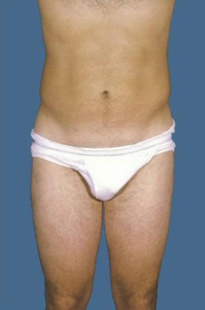 New York Plastic Surgery liposuction after — New York, NY