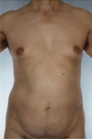 New York Plastic Surgery liposuction after — New York, NY