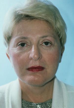 New York Plastic Surgery facelift after — New York, NY