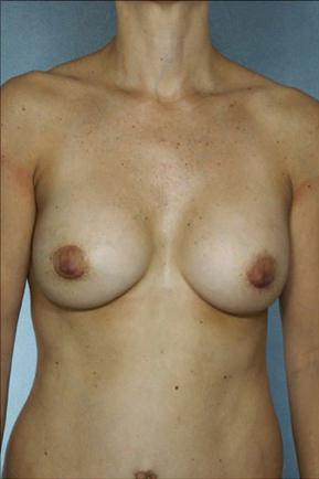 New York Plastic Surgery breast augmentation after — New York, NY