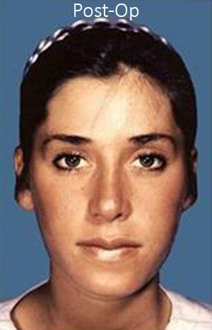 New York Plastic Surgery rhinoplasty after — New York, NY