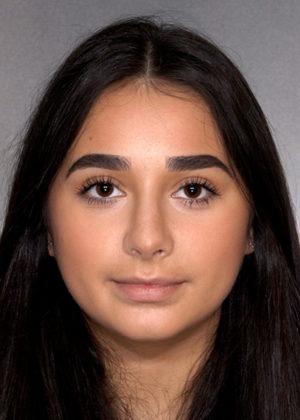 New York Plastic Surgery rhinoplasty after — New York, NY