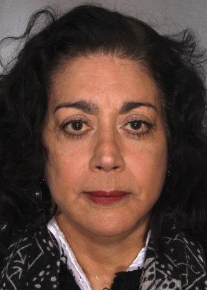 New York Plastic Surgery facelift after — New York, NY