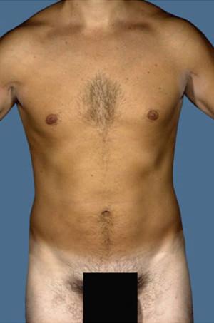 Liposuction after at New York Plastic Surgery in New York, NY