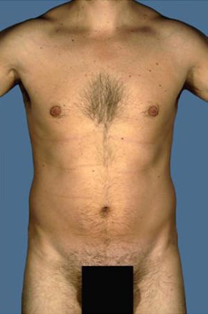 Liposuction before at New York Plastic Surgery in New York, NY