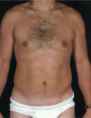 New York Plastic Surgery liposuction after — New York, NY