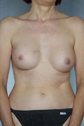 New York Plastic Surgery breast augmentation after — New York, NY