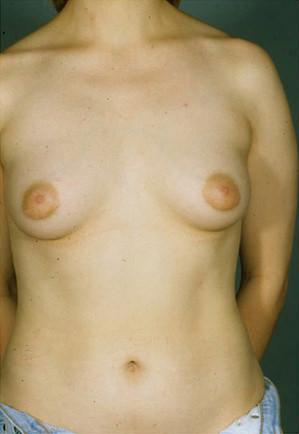 New York Plastic Surgery breast augmentation after — New York, NY
