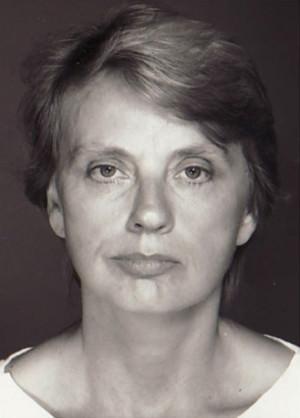 New York Plastic Surgery facelift after — New York, NY